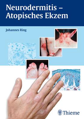 Ring |  Neurodermitis - Atopisches Ekzem | eBook | Sack Fachmedien