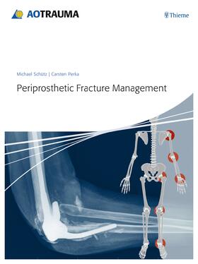 Schütz / Perka |  Periprosthetic Fracture Management | Buch |  Sack Fachmedien