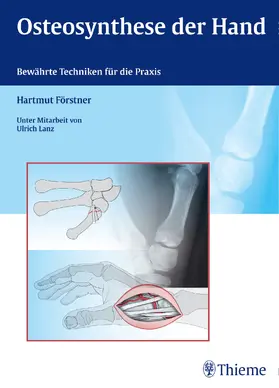 Förstner |  Osteosynthese der Hand | eBook | Sack Fachmedien