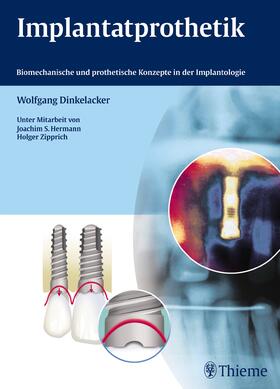 Dinkelacker, Wolfgang |  Implantatprothetik | eBook | Sack Fachmedien