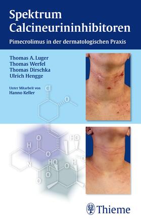 Luger / Dirschka / Hengge |  Spektrum Calcineurininhibitoren: Pimecrolimus in der dermatologischen Praxis | Buch |  Sack Fachmedien