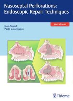 Alobid / Castelnuovo |  Nasoseptal Perforations: Endoscopic Repair Techniques | Buch |  Sack Fachmedien