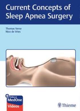Verse / de Vries / Vries |  Current Concepts of Sleep Apnea Surgery | Buch |  Sack Fachmedien
