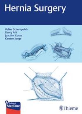 Schumpelick / Arlt / Conze |  Hernia Surgery | Buch |  Sack Fachmedien