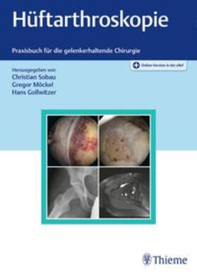 Sobau / Möckel / Gollwitzer |  Hüftarthroskopie | Buch |  Sack Fachmedien