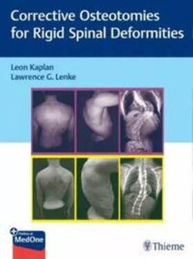 Kaplan / Lenke |  Corrective Osteotomies for Rigid Spinal Deformities | eBook | Sack Fachmedien