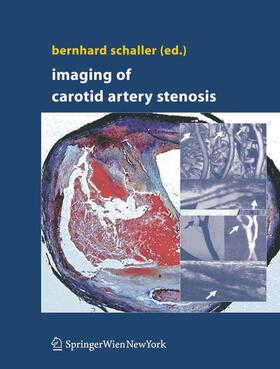 Schaller |  Imaging of Carotid Artery Stenosis | Buch |  Sack Fachmedien