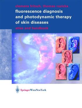 Ruzicka / Fritsch |  Fluorescence Diagnosis and Photodynamic Therapy of Skin Diseases | Buch |  Sack Fachmedien