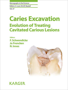 Schwendicke / Frencken / Innes |  Caries Excavation: Evolution of Treating Cavitated Carious Lesions | eBook | Sack Fachmedien