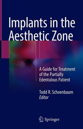 Schoenbaum |  Implants in the Aesthetic Zone | Buch |  Sack Fachmedien