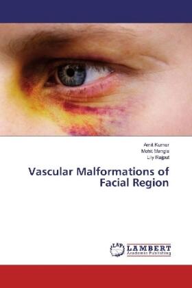 Kumar / Mangla / Rajput |  Vascular Malformations of Facial Region | Buch |  Sack Fachmedien