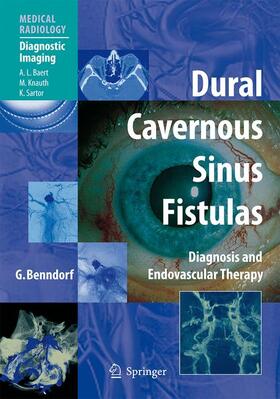 Benndorf |  Dural Cavernous Sinus Fistulas | Buch |  Sack Fachmedien