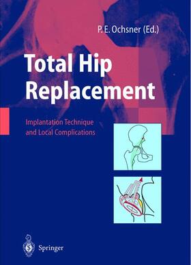 Ochsner |  Total Hip Replacement | Buch |  Sack Fachmedien