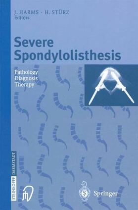 Stürz / Harms |  Severe Spondylolisthesis | Buch |  Sack Fachmedien