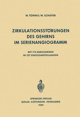 Schiefer / Tönnis |  Zirkulationsstörungen des Gehirns im Serienangiogramm | Buch |  Sack Fachmedien
