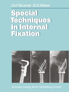 Brunner / Weber |  Special Techniques in Internal Fixation | Buch |  Sack Fachmedien