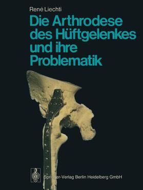 Liechti |  Die Arthrodese des Hüftgelenkes und ihre Problematik | Buch |  Sack Fachmedien