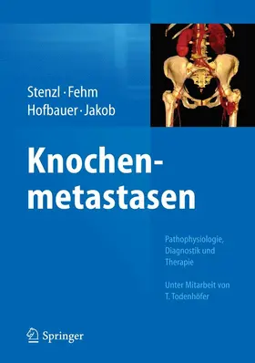 Stenzl / Fehm / Hofbauer |  Knochenmetastasen | eBook | Sack Fachmedien