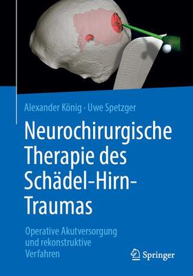 Spetzger / König |  Neurochirurgische Therapie des Schädel-Hirn-Traumas | Buch |  Sack Fachmedien