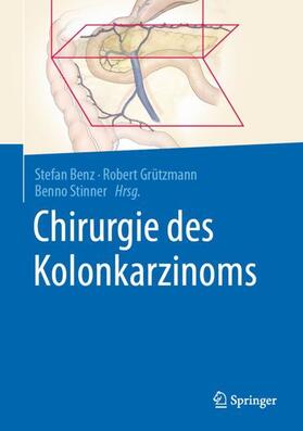 Benz / Grützmann / Stinner |  Chirurgie des Kolonkarzinoms | Buch |  Sack Fachmedien