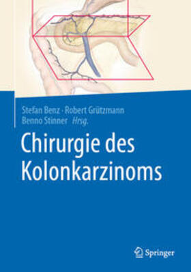 Benz / Grützmann / Stinner |  Chirurgie des Kolonkarzinoms | eBook | Sack Fachmedien