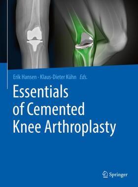 Kühn / Hansen |  Essentials of Cemented Knee Arthroplasty | Buch |  Sack Fachmedien