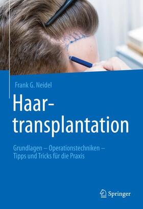 Neidel |  Haartransplantation | Buch |  Sack Fachmedien