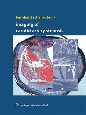 Schaller |  Imaging of Carotid Artery Stenosis | Buch |  Sack Fachmedien