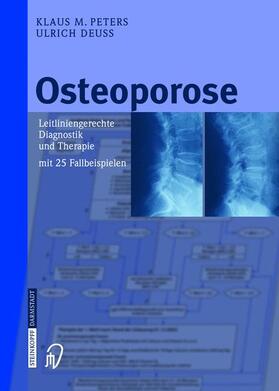 Deuß / Peters |  Osteoporose | Buch |  Sack Fachmedien