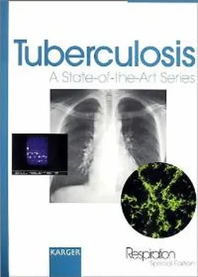  Tuberculosis | Buch |  Sack Fachmedien