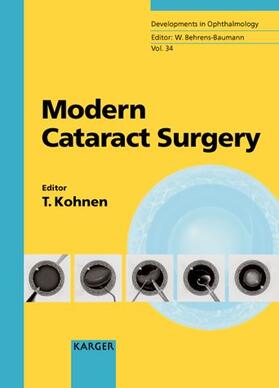 Kohnen |  Modern Cataract Surgery | Buch |  Sack Fachmedien