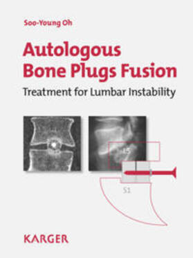 Oh |  Autologous Bone Plugs Fusion | Buch |  Sack Fachmedien