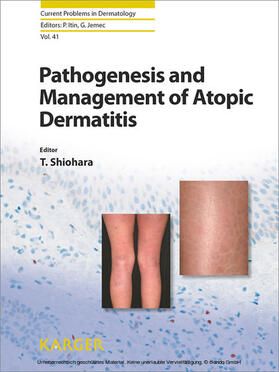 Shiohara |  Pathogenesis and Management of Atopic Dermatitis | eBook | Sack Fachmedien