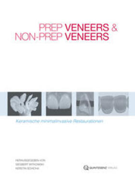 Witkowski / Schicha |  Prep Veneers und Non-Prep Veneers | Buch |  Sack Fachmedien