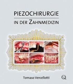 Vercellotti |  Piezochirurgie in der Zahnmedizin | Buch |  Sack Fachmedien