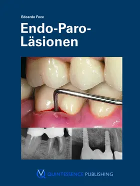 Foce |  Endo-Paro-Läsionen | eBook | Sack Fachmedien