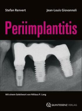 Renvert / Giovannoli |  Renvert, S: Periimplantitis | Buch |  Sack Fachmedien