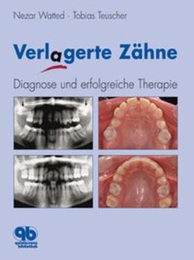 Watted / Teuscher |  Verlagerte Zähne | Buch |  Sack Fachmedien