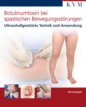 Hustedt |  Botulinumtoxin bei spastischen Bewegungsstörungen | Buch |  Sack Fachmedien