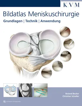 Becker / Schaller |  Bildatlas Meniskuschirurgie | Buch |  Sack Fachmedien