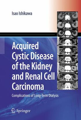 Ishikawa |  Acquired Cystic Disease of the Kidney and Renal Cell Carcinoma | Buch |  Sack Fachmedien