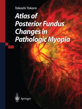 Tokoro |  Atlas of Posterior Fundus Changes in Pathologic Myopia | Buch |  Sack Fachmedien