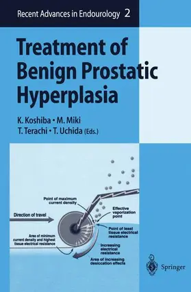 Koshiba / Uchida / Miki |  Treatment of Benign Prostatic Hyperplasia | Buch |  Sack Fachmedien