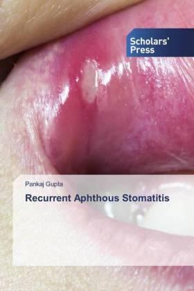 Gupta |  Recurrent Aphthous Stomatitis | Buch |  Sack Fachmedien