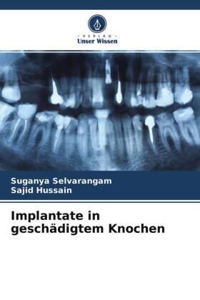 Selvarangam / Hussain |  Implantate in geschädigtem Knochen | Buch |  Sack Fachmedien