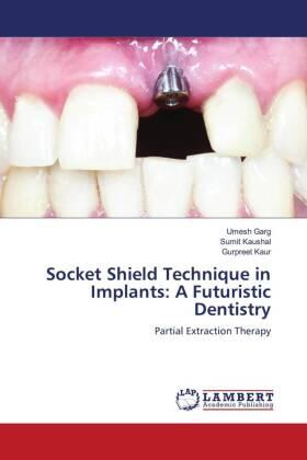 Garg / Kaushal / Kaur |  Socket Shield Technique in Implants: A Futuristic Dentistry | Buch |  Sack Fachmedien