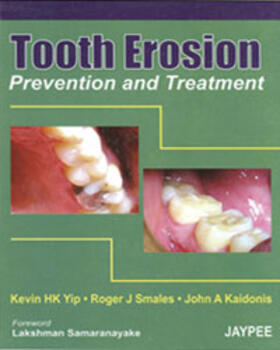Yip / Smales / Kaidonis |  Tooth Erosion Prevention and Treatment | Buch |  Sack Fachmedien