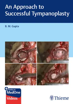 Gupta |  An Approach to Successful Tympanoplasty | eBook | Sack Fachmedien