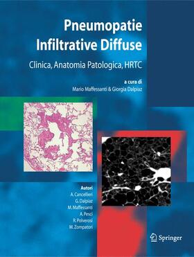 Maffessanti / Dalpiaz |  Pneumopatie Infiltrative Diffuse | Buch |  Sack Fachmedien