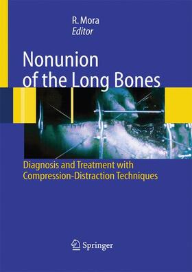 Mora |  Nonunion of the Long Bones | Buch |  Sack Fachmedien